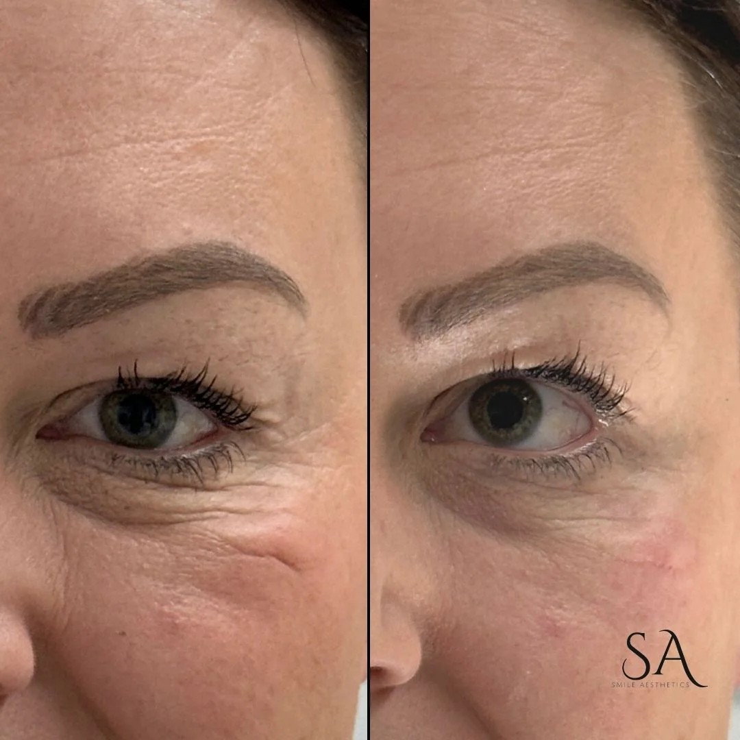 Dermal Fillers Cardiff