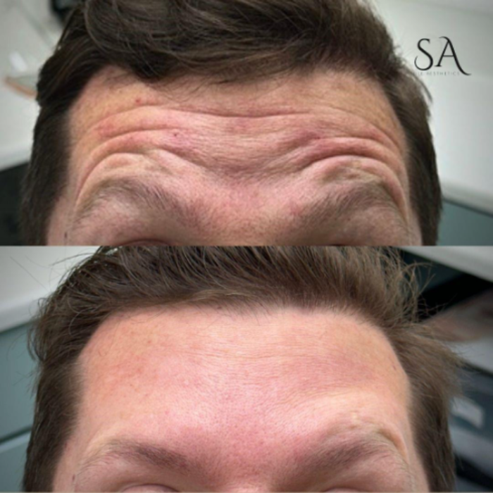 Anti Wrinkle Cardiff