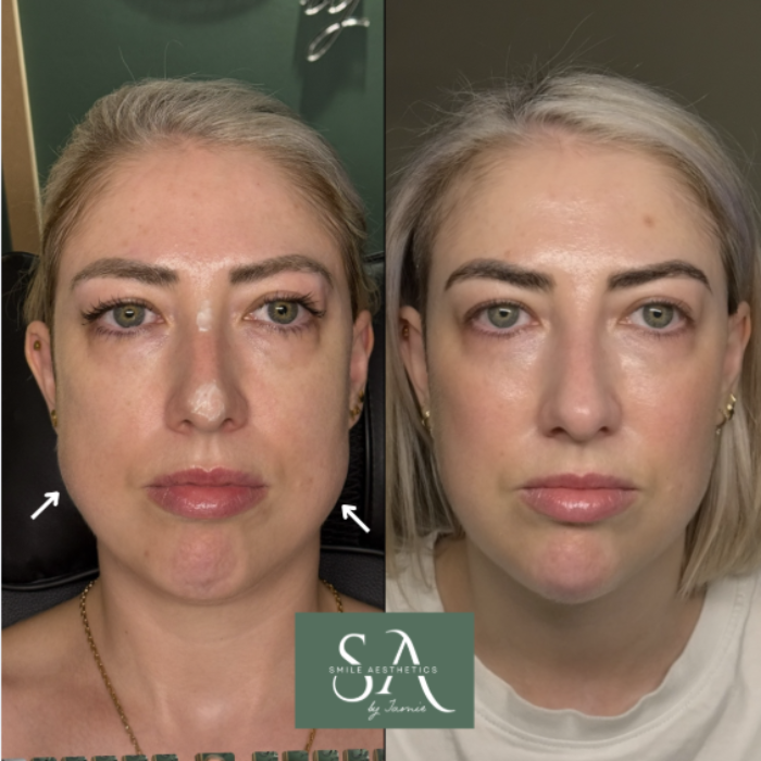 TMJ Botox Cardiff
