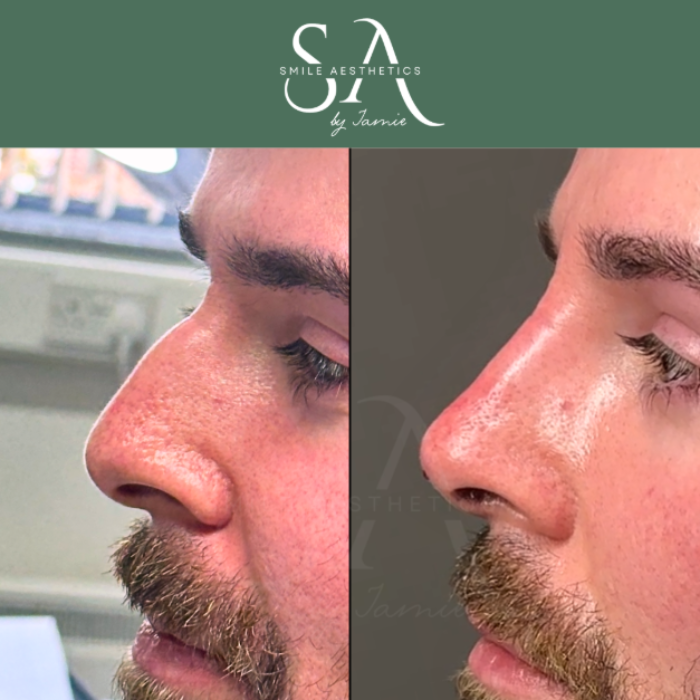 Non Surgical Nose Job Cardiff